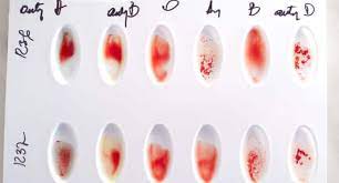 How to Tell Blood Type From Lab Results